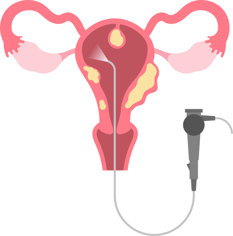 Uterus cancer tumor exam cervical polyps removal surgery fibroids and vaginal bleeding heavy period pelvic pain IUD biopsy
